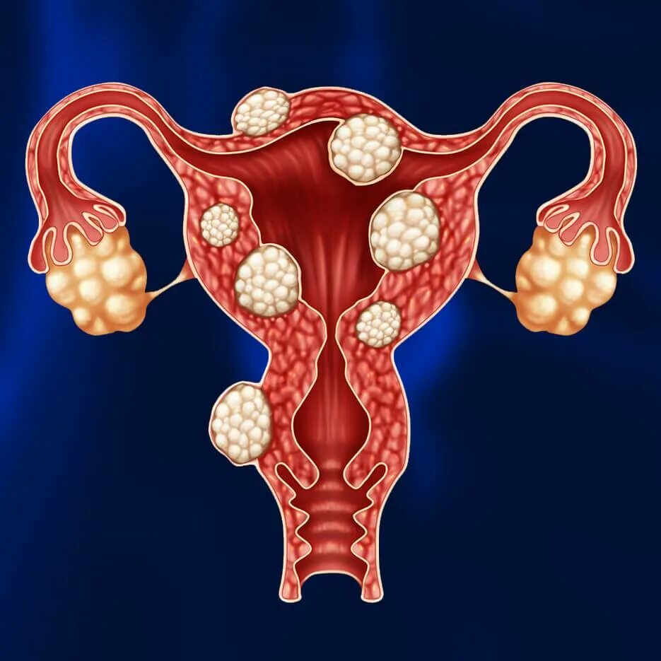Миома матки стадии