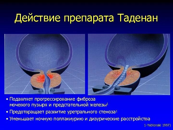 Фиброз простаты что это такое. Фиброз предстательной железы. фиброз мочевого пузыря у мужчин.