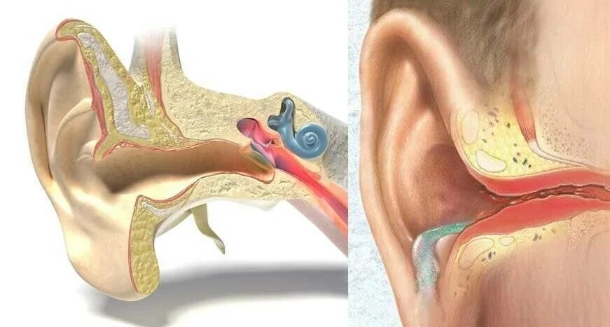 Евстахиит барабанная перепонка. Хронический отит наружного уха. Острый евстахиит