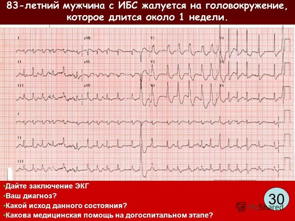 ишемическая болезнь сердца на экг. ишемическая болезнь сердца на экг. экг при ишемическом повреждении и ишемии. экг при ишемии миокарда на передней стенке. субэндокардиальная ишемия на экг.