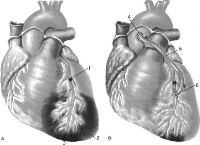 Аорта коронарное шунтирование. Инфаркт шунтирование аортокоронарное шунтирование. Аорта....аортокоронарное...шунтирование. Коронарное шунтирование ПМЖВ. Что такое шунтирование сердца и сосудов