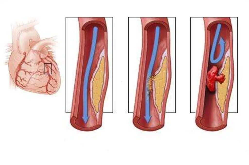 Тромбоз коронарных артерий. Тромбоз коронарных сосудов. Тромбоз артериальных сосудов. Острый тромбоз коронарных артерий. Закупорка тромбов в коронарной артерии.