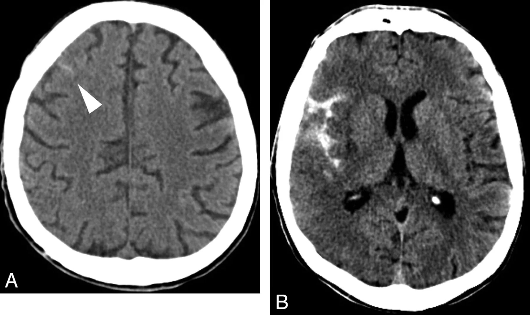 Неравномерное расширение конвекситального. Subarachnoid Hemorrhage CT. Субарахноидальное пространство на кт. Субарахноидальные пространства на кт.