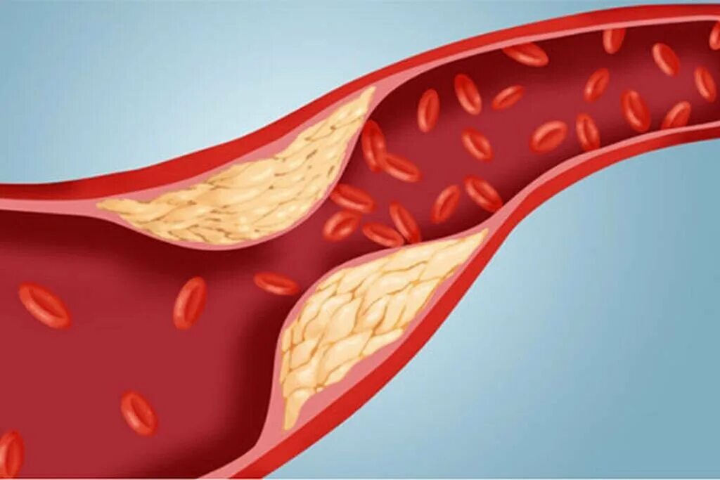 Как очистить сосуды от холестериновых тромбов. Холестериновые бляшки в сосудах. Атеросклеротические бляшки в сосудах.