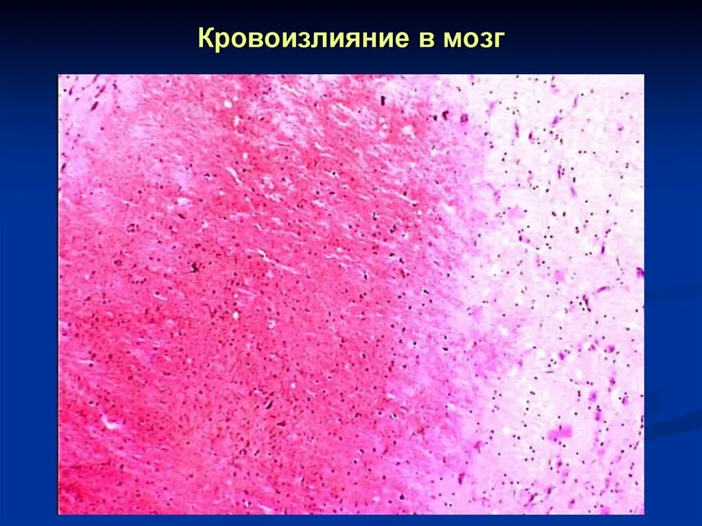 Кровоизлияние патанатомия. Кровоизлияние патанатомия. Кровоизлияние патанатомия. Кровоизлияние патанатомия. Очаги кровоизлияний в головном мозге микропрепарат.
