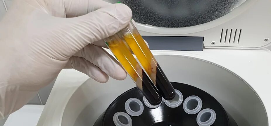 Лечению суставов плазмолифтингом. Prp-терапия (platelet rich plasma). плазмотерапия сустав prp. prp плазмолифтинг суставов.