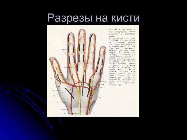 Суставной панариций разрезы. Линии разрезов кожи на кисти. Разрезы на кисти. Флегмоны возвышения 1 пальца. Флегмона пальца кисти разрезы.
