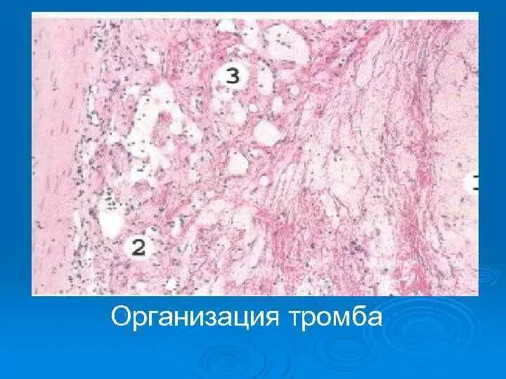 Смешанный тромб препарат патанатомия. Организация тромба микропрепарат патанатомия. Красный обтурирующий тромб микропрепарат. Фибриновый тромб гистология. Тромб микропрепарат