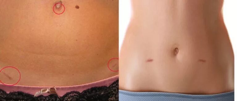 Швы после лапароскопии желчного пузыря как выглядят Gallbladder Stones Surgery Cost in Hyderabad Dr V Pareek
