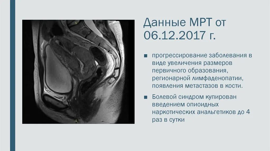 Полип эндометрия в матке мрт. Образование шейки матки мрт.