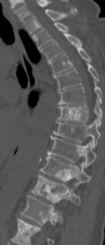 Очаговые изменения костей. Метастазы позвонков на кт. Остеобластические метастазы позвоночника на кт. Метастазы в тела позвонков кт. Метастазы в позвоночнике на кт.