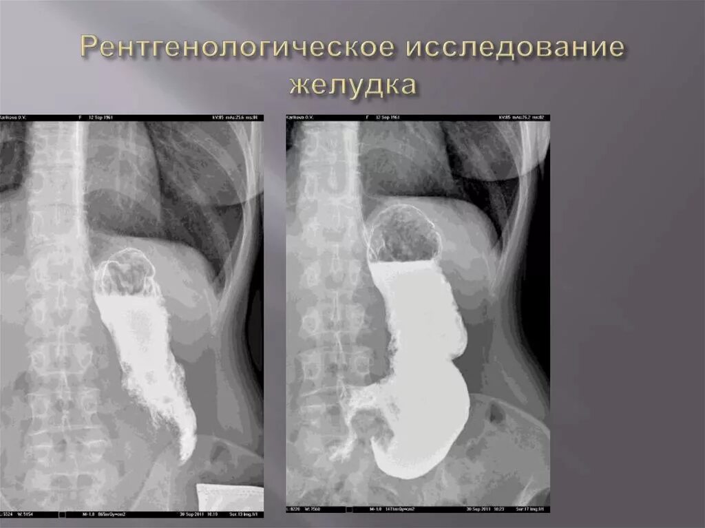 Рентгеноскопия пищевода подготовка