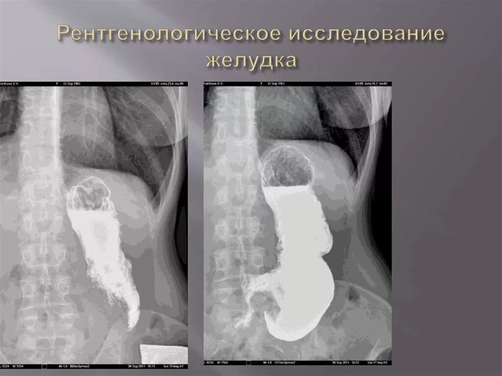 Рентгеноскопия пищевода и желудка с барием. Рентгеноконтрастное исследование пищевода с барием. рентгеноскопия желудка с барием. rentgenologicheskiye isledovaniya isledovaniya jeludka. рентгеноскопия желудка метод исследования.