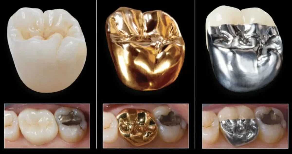 Металлические коронки на жевательные зубы. Коронки для жевательных зубов. Металлокерамическая коронка.