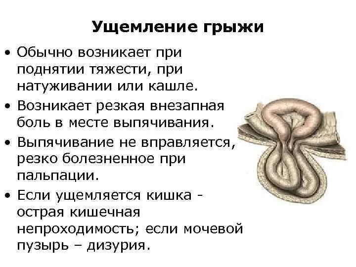 Ущемленная брюшной грыжа