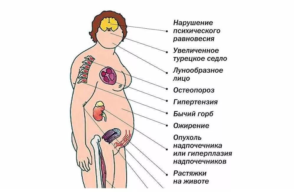 Какие заболевания надпочечников. Клинические симптомы болезни Иценко-Кушинга. .Болезнь Иценко Кушинга болезнь Кушинга. Синдром Иценко Кушинга проявления. Синдром Иценко Кушинга симптомы.