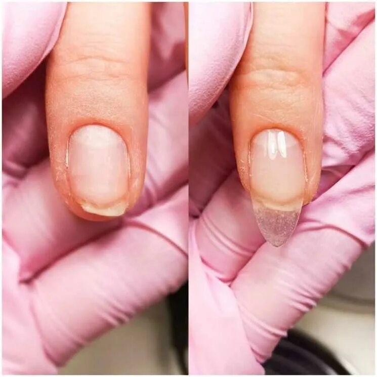 Изменение формы ногтей. Боковой онихолизис онихолизис. Ногтевая пластина.
