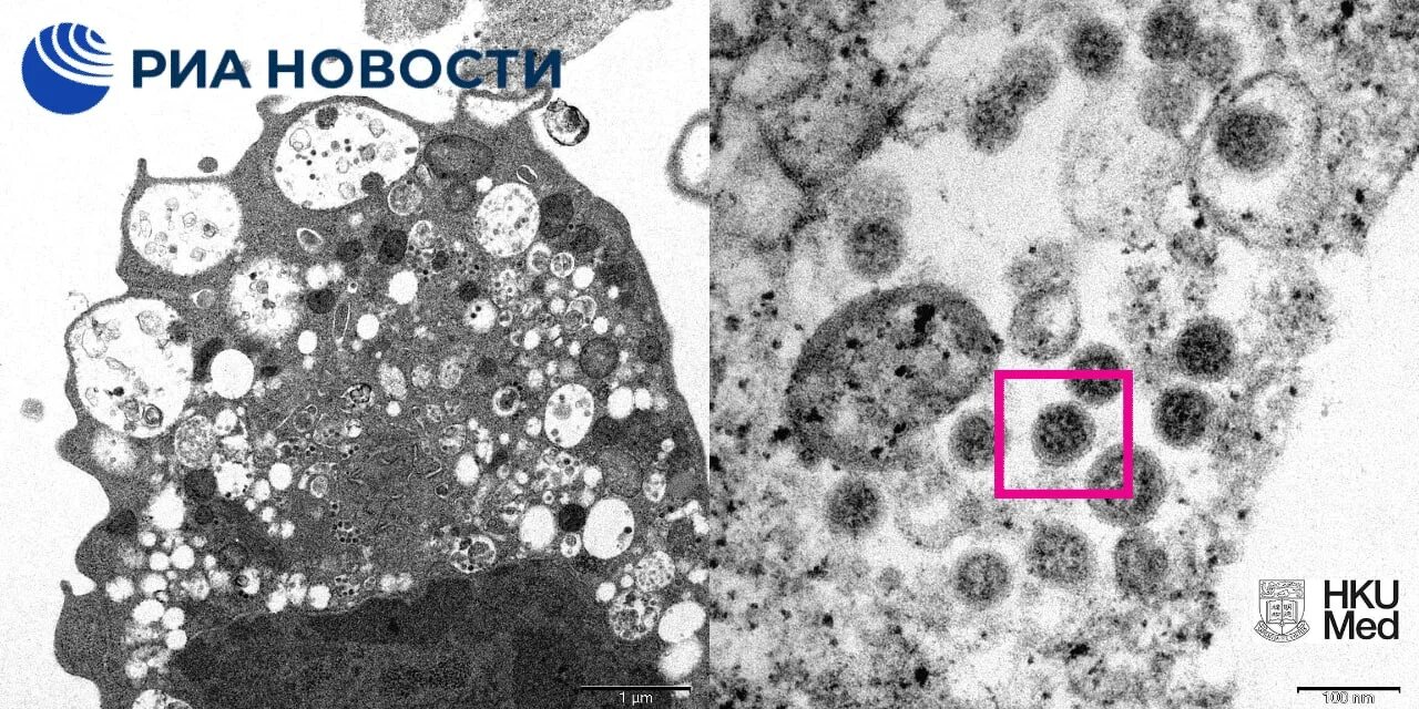 Отсутствие коронавируса. Омикрон-штамм SARS-cov-2. Электронная микрофотография коронавируса. Вирус коронавируса под микроскопом. Омикрон коронавирус.