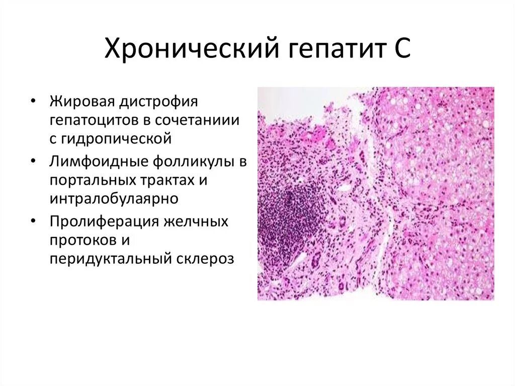 Хронический вирусный гепатит микропрепарат. Хронический гепатит с жировой дистрофией гепатоцитов. Хронический вирусный гепатит c. Хронический гепатит гистология.