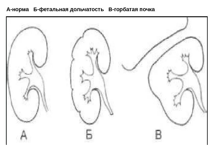 Бугристый контур почки на УЗИ. Контуры почек неровные. Фестончатость контуров почки. Горбатая почка