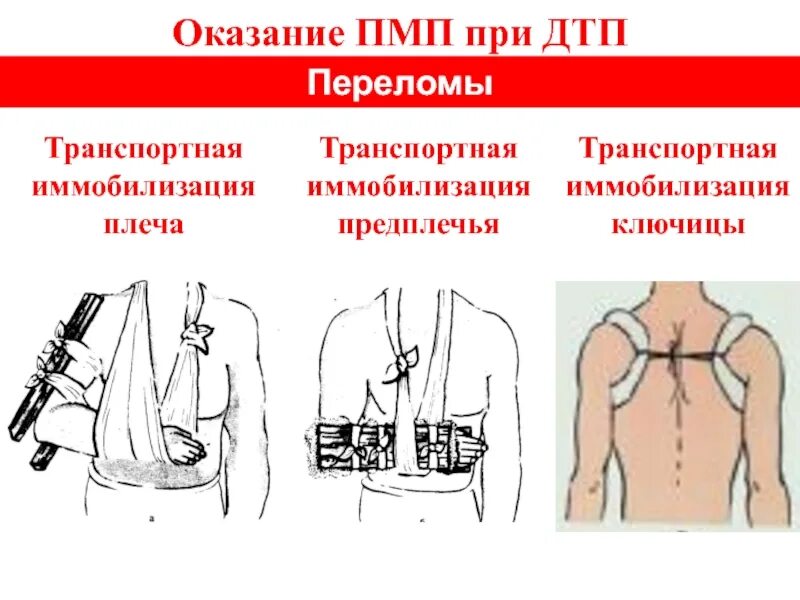 Оказание помощи при переломе ключицы. Перелом ключицы транспортная иммобилизация. транспортная иммобилизация при переломе ключицы. перелом предплечья иммобилизация. транспортная иммобилизация при переломе ключицы осуществляется:.