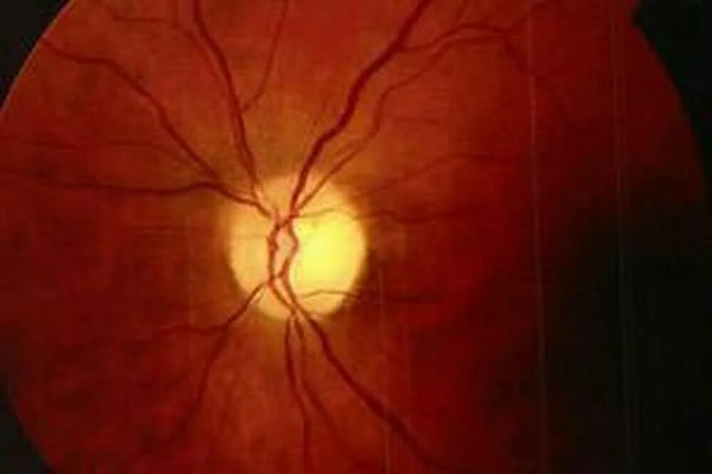 Размеры зрительных нервов. Частичная атрофия зрительного нерва. Частичная атрофия зрительного нерва глазное дно. Атрофия зрительного нерва Лебера. Атрофия зрительного нерва мкб.