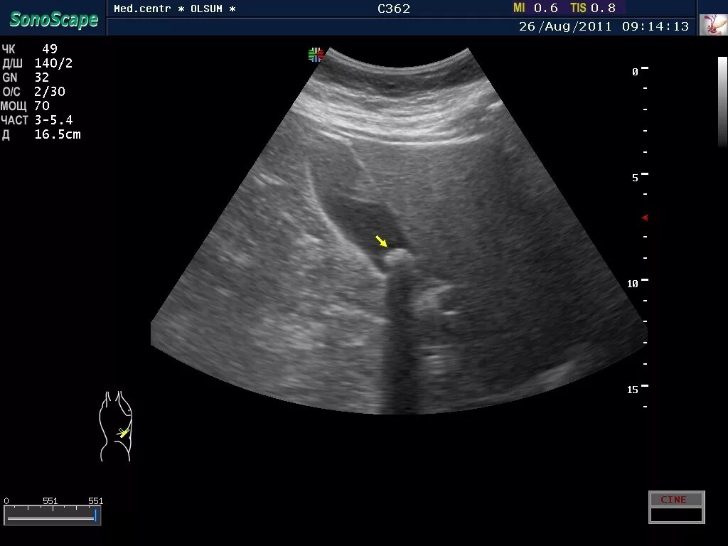 Узи жкб. Желчекаменная болезнь УЗИ. УЗИ желчного пузыря ЖКБ. Эхограмма желчного пузыря. Синехии желчного пузыря УЗИ.