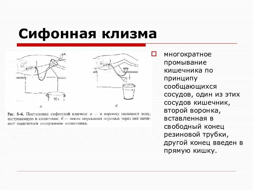 Глубина зонда при сифонной клизме. Глубина постановки сифонной клизмы. Промывание желудка сифонная клизма алгоритм. Постановка сифонной клизмы. Сифонная клизма объем жидкости.