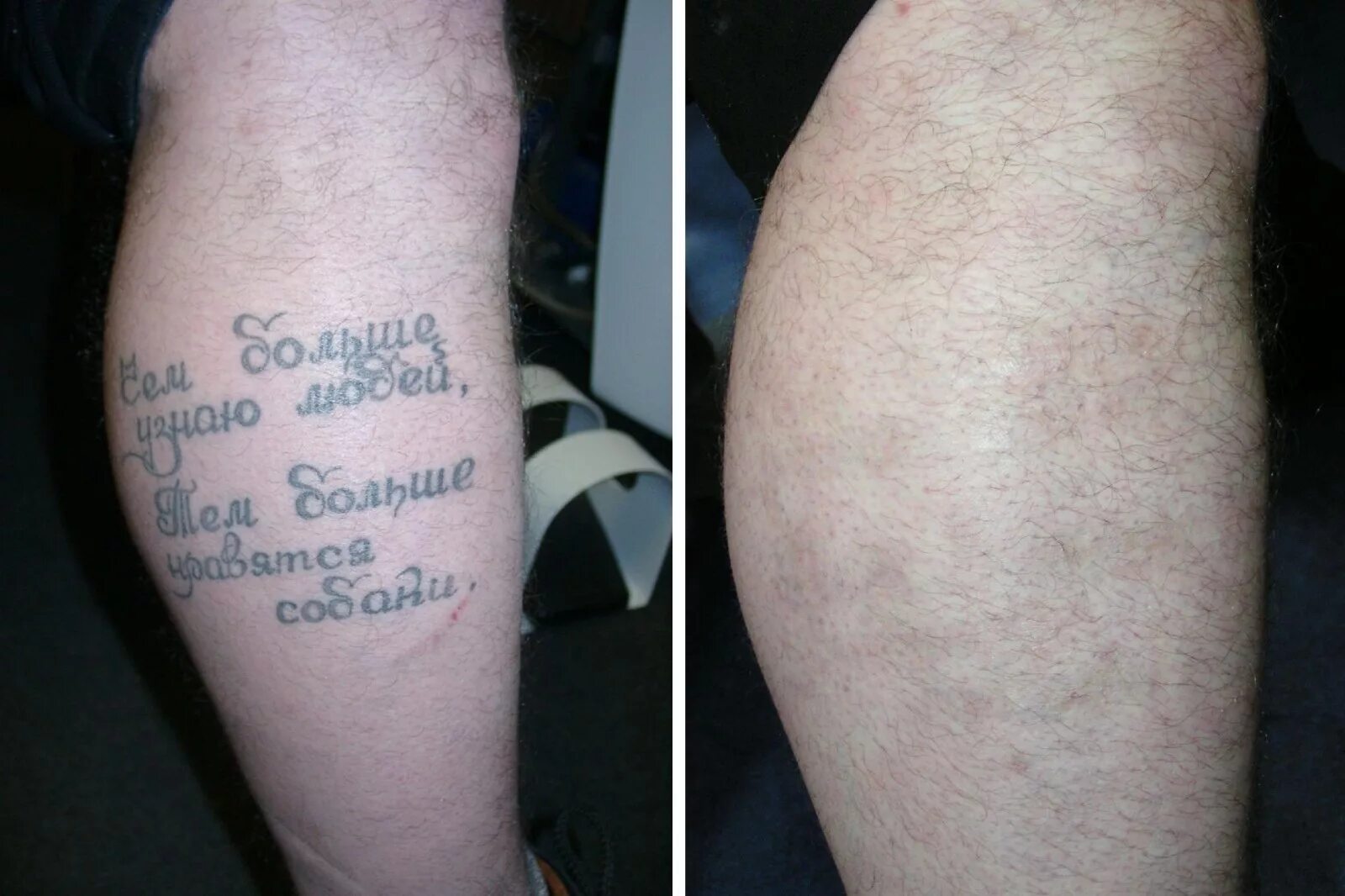 Удалить тату лазером. Татуировки после сведения.