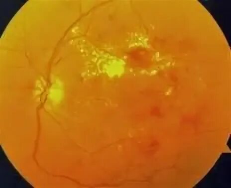 Макулопатия макулярный отек. Глазное дно при отслойке сетчатки. Флюоресцентная ангиография глазного дна. Солнечная макулопатия.