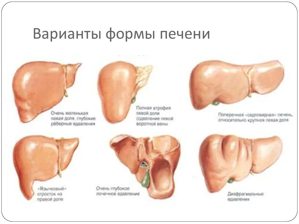 Левая печень увеличена. Аномалии развития левой доли печени. Саблевидная форма левой доли печени.