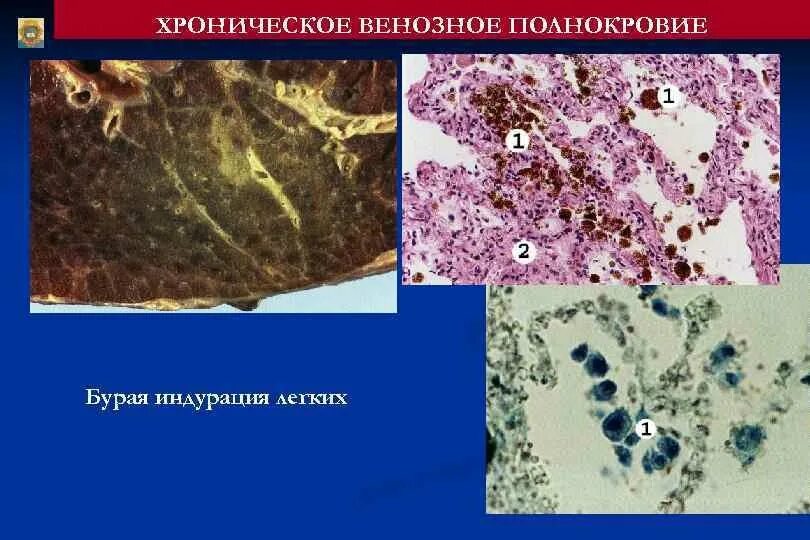 Венозное полнокровие печени препарат. Микропрепарат бурая индурация легких реакция перлса. Хроническое венозное полнокровие микропрепарат. Бурая индурация легкого реакция перлса. Хроническое венозное полнокровие в селезенке характеризуется.