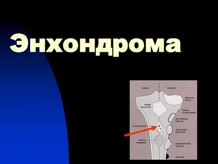 Энхондрома бедренной кости