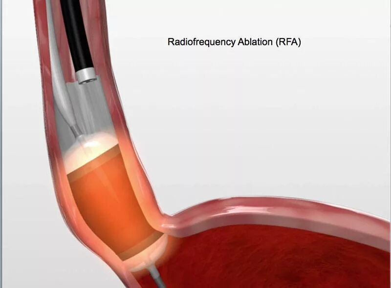 Радиочастотная абляция пищевода Барретта. Аргоноплазменная абляция пищевода. Радиочастотная катетерная абляция. Абляция пищевода