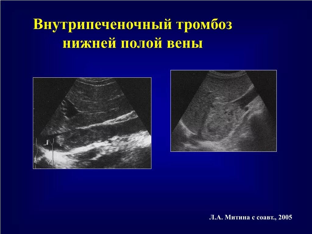 Тромбоза вен печени. Тромб нижней полой вены УЗИ. Тромб в нижней полой Вене на УЗИ.