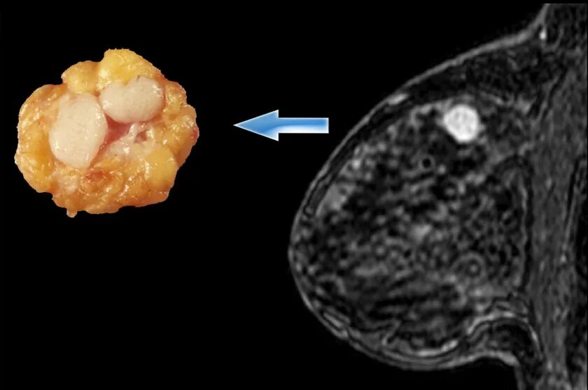 Листовидная фиброаденома молочной. Филлоидная фиброаденома. Аденома и фиброаденома молочной железы. Доброкачественная опухоль фиброаденома. Злокачественная опухоль лечится