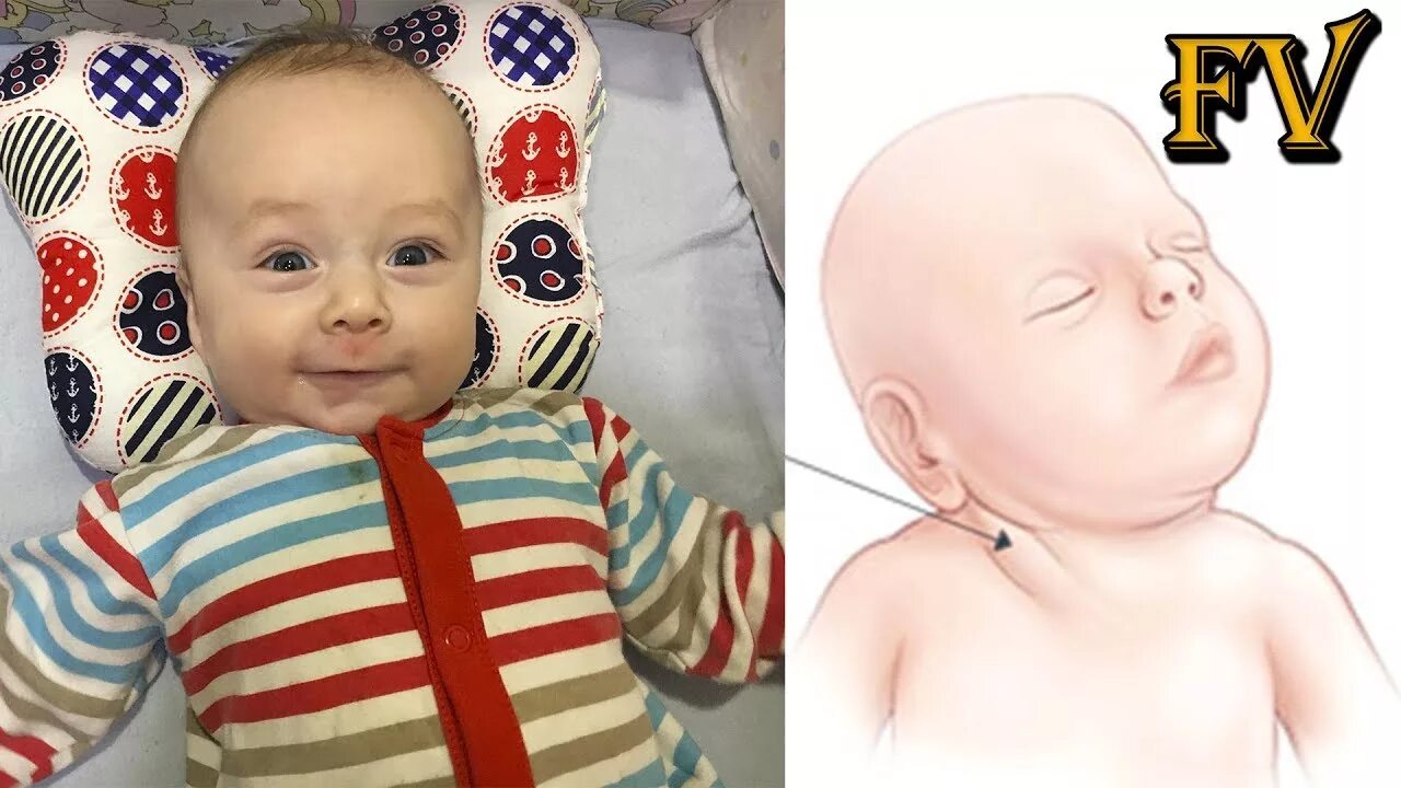 Кривошея и деформация черепа. Кривошее у новорожденного. Малыш поворачивает голову в одну сторону. Кривошея деформация головы у ребенка. Держать голову набок