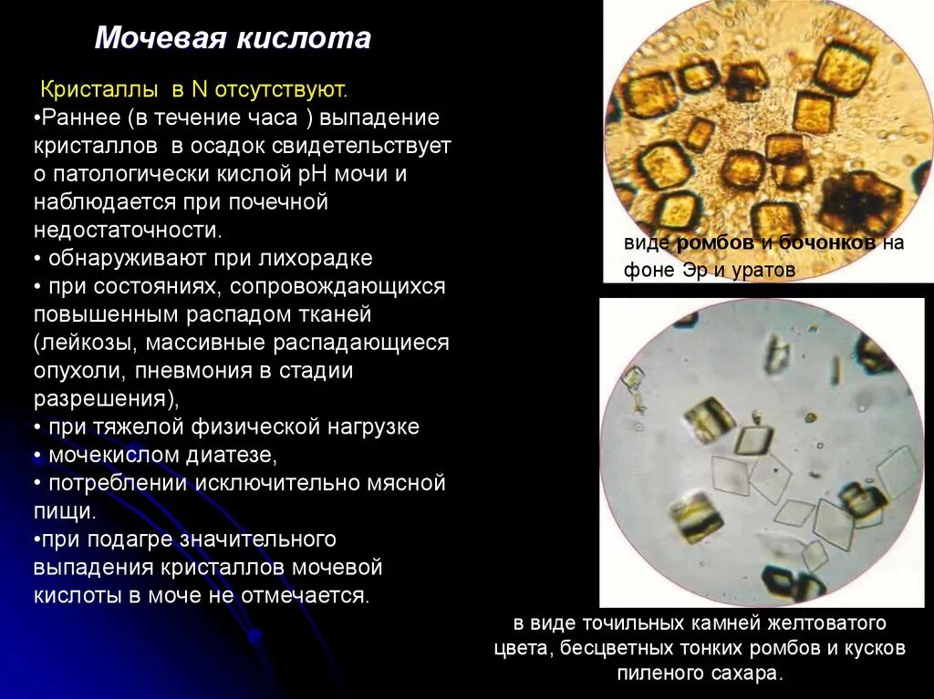 Распад мочи. Мочевая кислота в моче РН. Кристаллы соли мочевой кислоты. Кристаллы мочевой кислоты в моче. Соли мочевая кислота повышены в моче.