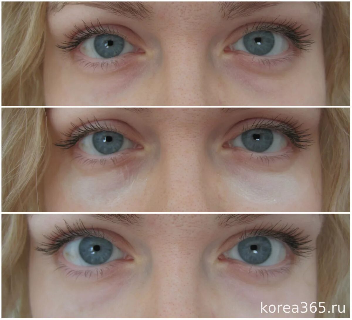 отбеливание лица до и после. мезотерапия глаз от темных кругов. осветлить под глазами. отбелить кожу под глазами. осветлить под глазами.