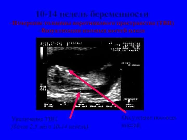 УЗИ измерение носовой кости. ТВП И носовая кость. Аплазия носовой кости у плода 12. Носовая кость в 10 недель.