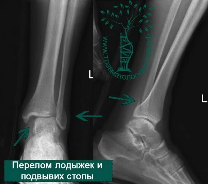 Перелом голеностопного сустава. Перелом лодыжки рентген. Перелом голеностопа рентген. Подвывих голеностопного сустава рентген. Разрыв связок голеностопного сустава рентген.