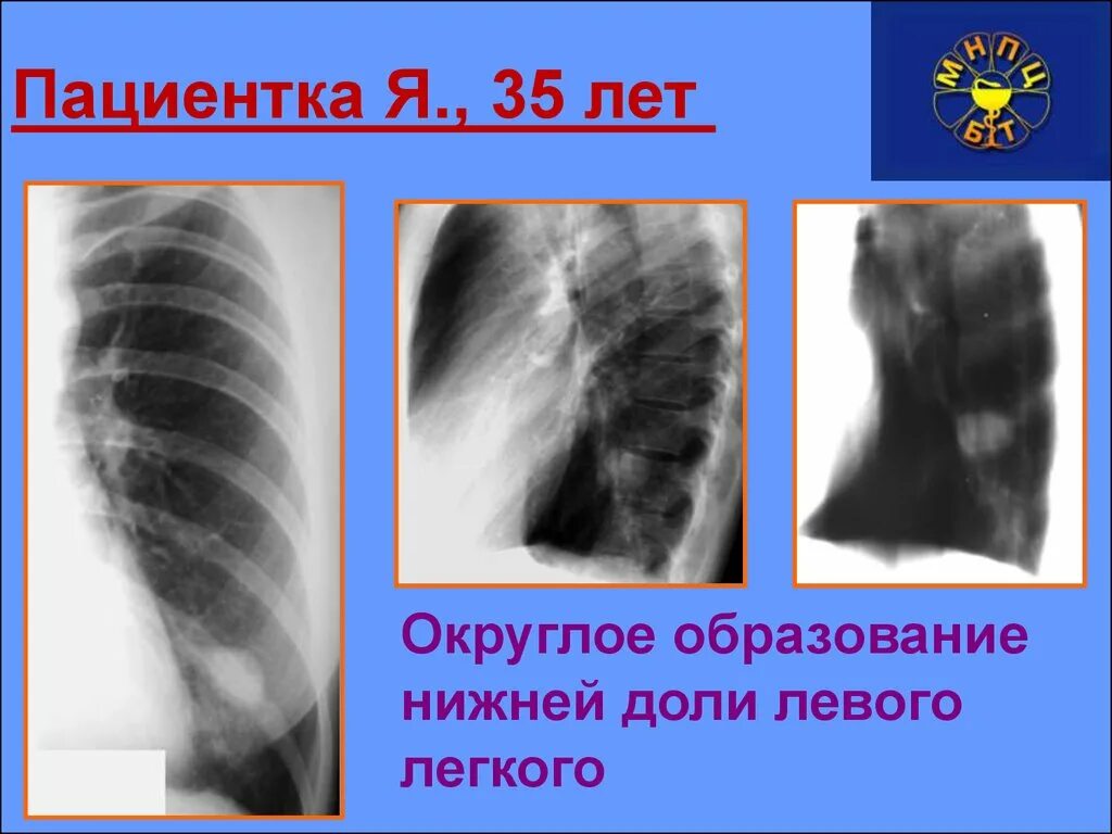 Образование нижней доли левого легкого. Затемнение доли легкого. Округлое образование в легких на рентгене. Затемнение нижних долей легких. Образование левой доли легкого