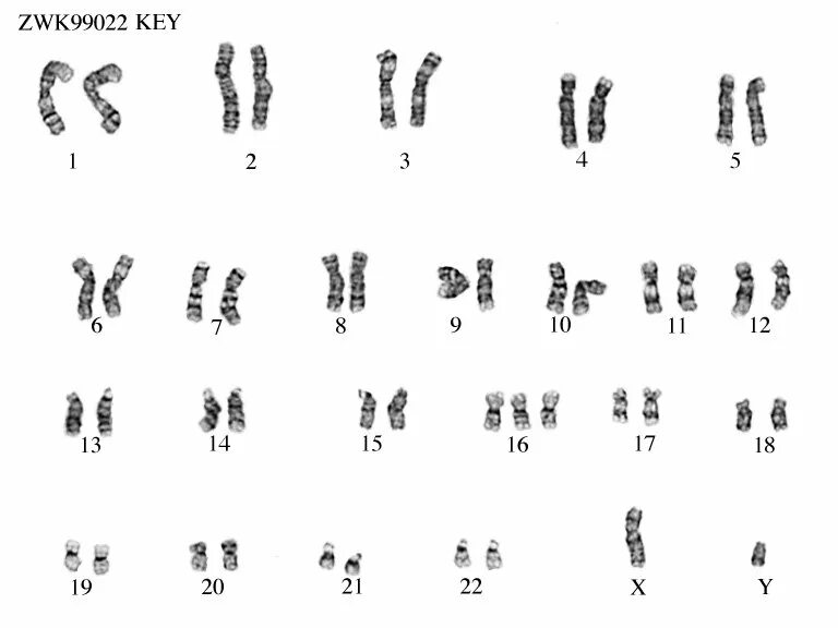 Хромосомы краба. Хромосомная патология трисомия хромосомы 16. Синдром Патау трисомия по 13 хромосоме кариотип. Трисомия 16 хромосомы синдром. Кариотип при синдроме Патау.