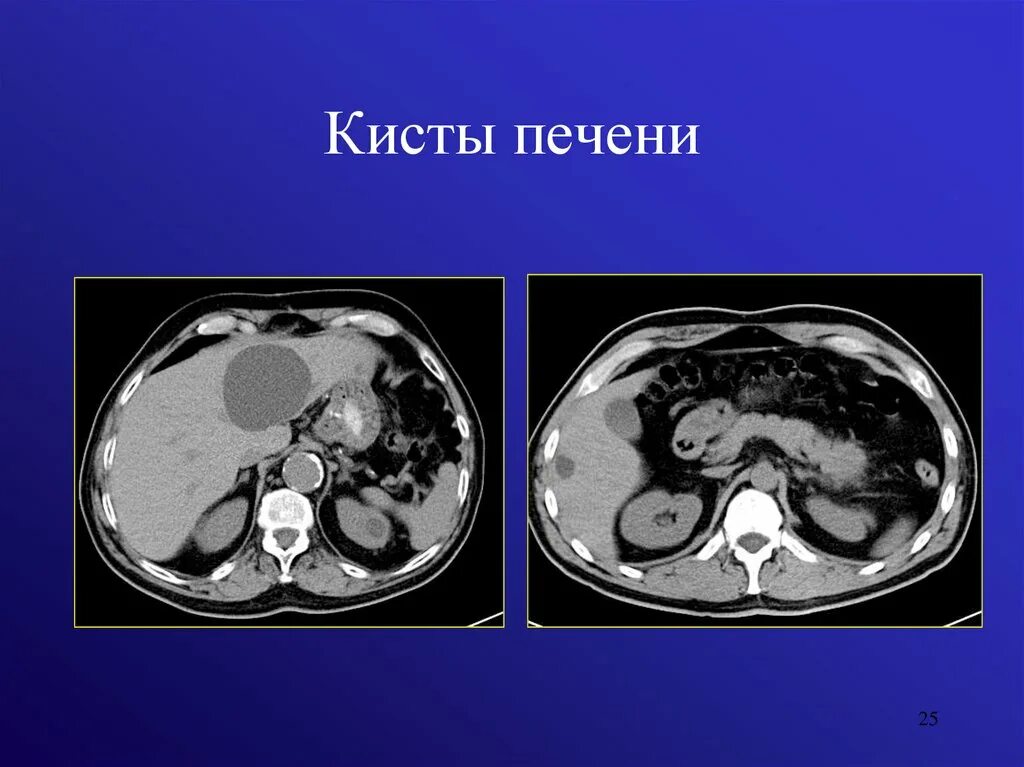 Киста печени мрт. Эхинококковая киста печени кт. Кисты печени кт эхинококкоз. Эхинококкоз брюшной полости кт.