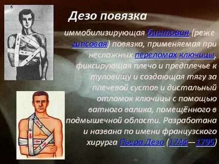 Дезо при переломе