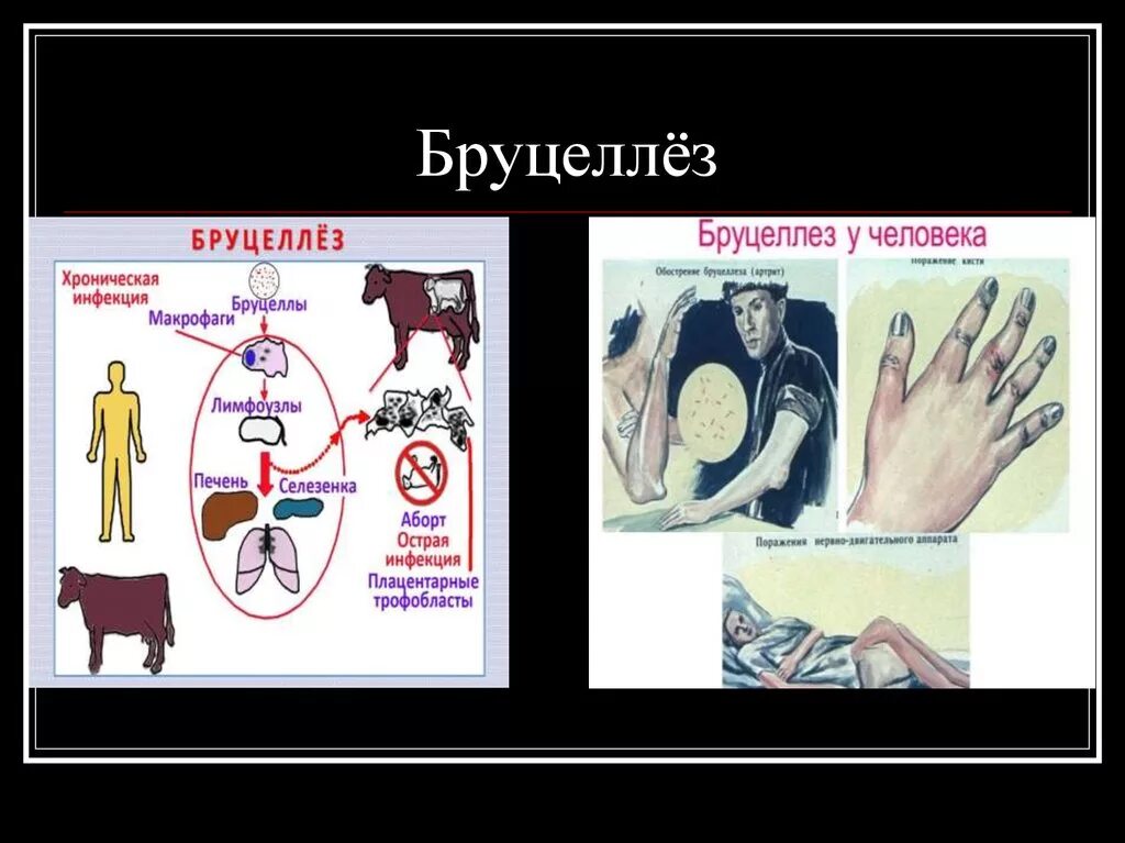 Что за болезнь бруцеллез у человека симптомы. Бруцеллез заболевание. ,Ehjwttp.