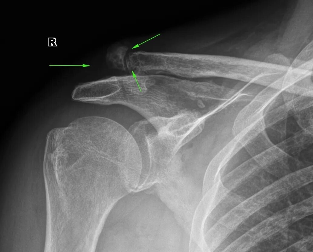 Лечение ключично акромиального артроза. Акромиальный перелом ключицы рентген. Рентген ключичного сустава это. Перелом акромиального отростка рентген. Перелом плечевого отростка рентген.