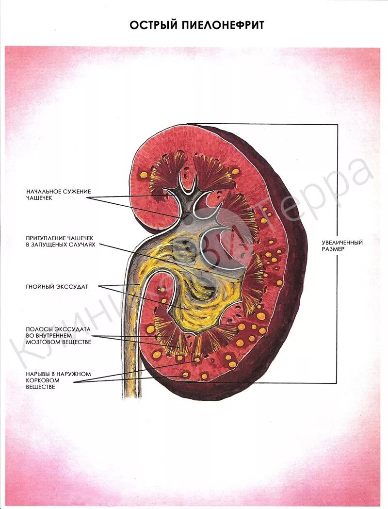Пиелонефрит описание. Первичный острый пиелонефрит. Хронический пиелонефрит строение почек. Острый пиелонефрит почка. Острый и хронический пиелонефрит.