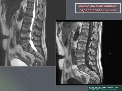 Миеломная болезнь мрт