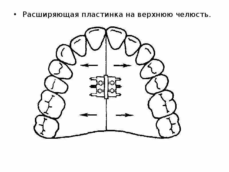 Пластина для расширения верхней челюсти. Расширить верхнюю челюсть. Пластинка для расширения верхней челюсти. Расширение челюсти цена